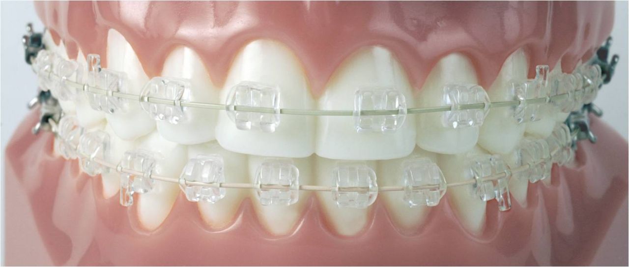 Lakewood CO Clear Braces Cost & Ceramic Braces Price